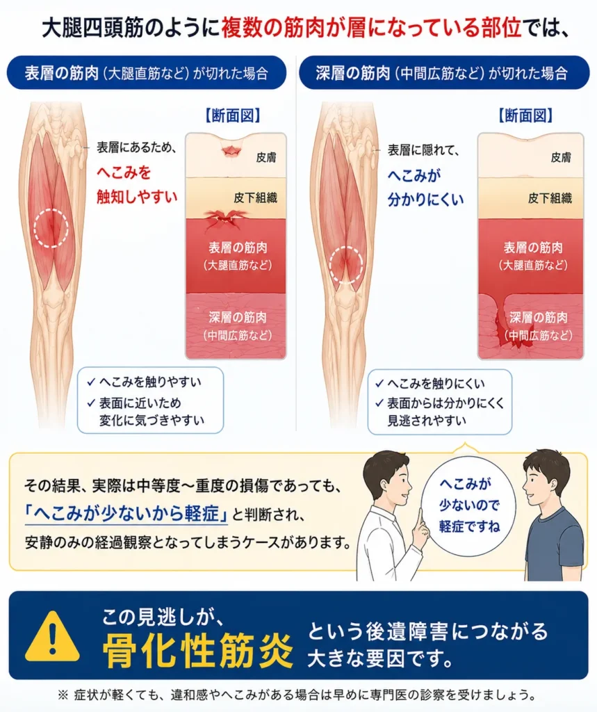 骨化性筋炎の解説