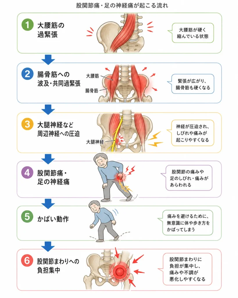 大腰筋の過緊張 → 腸骨筋への波及・共同過緊張 → 大腿神経など周辺神経への圧迫 → 股関節痛・足の神経痛 → かばい動作 → 股関節まわりへの負担集中